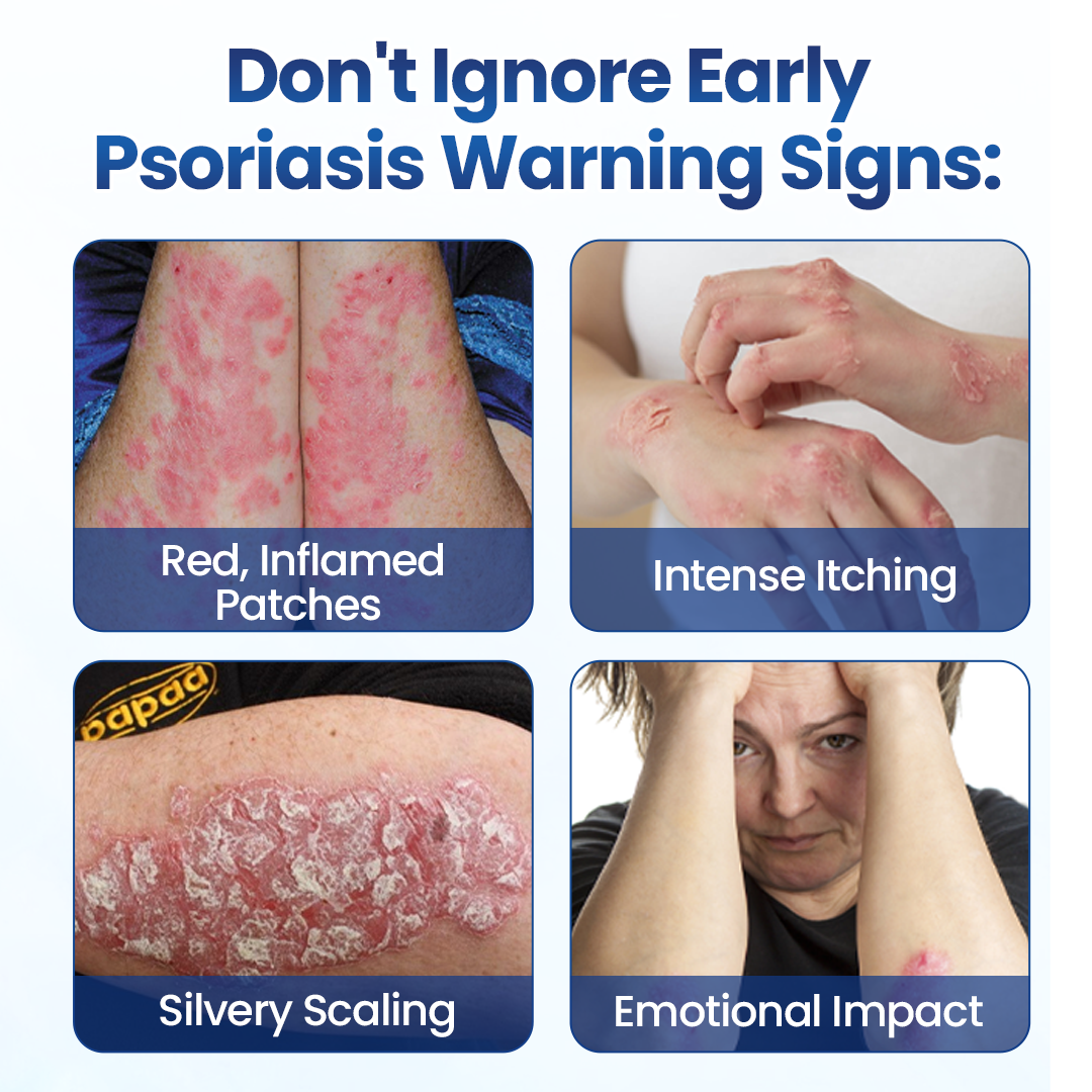 Psoriasis-prone skin warning signs graphic from the Cougex PsoriaMucin product page
